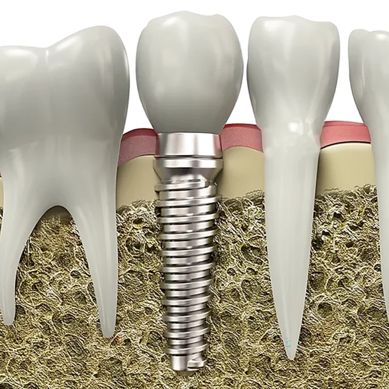 Cabinet dentaire des Drs Leclet - Blanchard et associés- Chartres implant